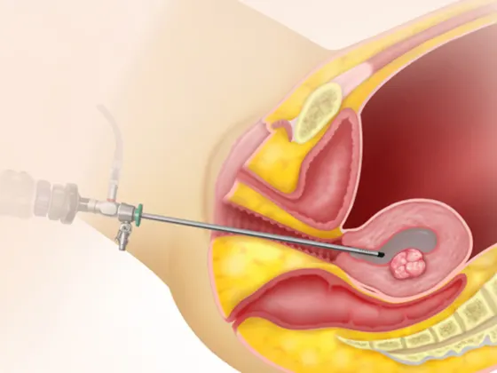 hysteroscopy