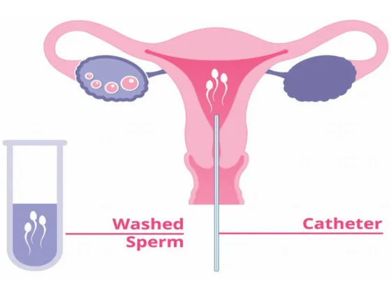iui