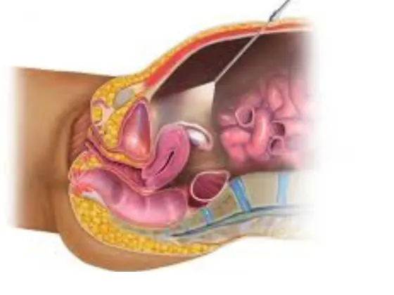 laproscopy