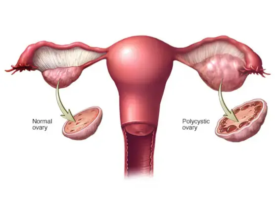 pcos